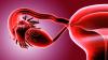 İnfertilite  nedir?